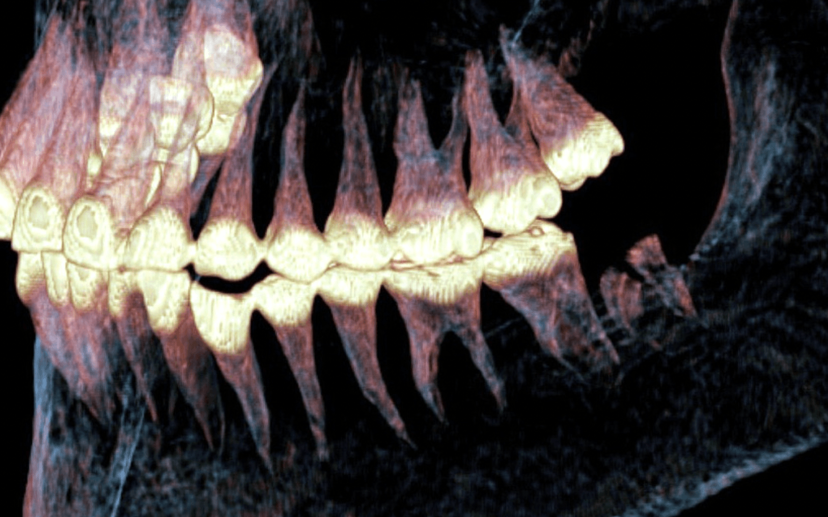 Российские учёные нашли доказательства сложнейшей челюстной операции возрастом 2500 лет